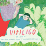 Vitiligo