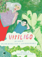 Vitiligo